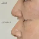 鼻尖形成＋切らない小鼻縮小（鼻翼縮小埋没法） after画像 サムネイル用