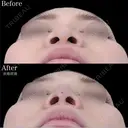 鼻尖形成＋TCBメッシュ after画像 サムネイル用