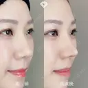 TCB式鼻先尖鋭術（だんご鼻解消） before画像 サムネイル用