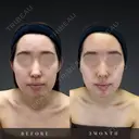 バッカルファット除去 after画像 サムネイル用