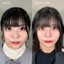 鼻尖形成＋TCB式鼻先尖鋭術（だんご鼻解消）＋TCBメッシュ＋小鼻縮小ボトックス注射 after画像 サムネイル用