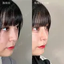 鼻尖形成＋TCB式鼻先尖鋭術（だんご鼻解消）＋TCBメッシュ＋小鼻縮小ボトックス注射 after画像 サムネイル用