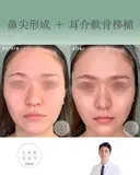 鼻尖形成+耳介軟骨移植 before画像 サムネイル用