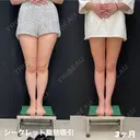 シークレット脂肪吸引太もも before画像 サムネイル用