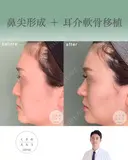 鼻尖形成+耳介軟骨移植 after画像 サムネイル用