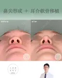 鼻尖形成+耳介軟骨移植 after画像 サムネイル用