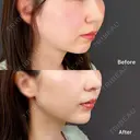 切らない顎形成 3D Eライン after画像 サムネイル用