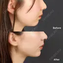 切らない顎形成 3D Eライン after画像 サムネイル用