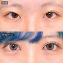 二重切開法（全切開・部分切開)＋目頭切開＋グラマラスライン形成（たれ目形成） after画像 サムネイル用