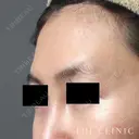 おでこの脂肪注入（CRF注入） before画像 サムネイル用