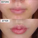 唇のヒアルロン酸注射 after画像 サムネイル用