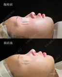 鼻プロテーゼ（隆鼻術）＋鼻尖形成＋鼻中隔延長術 after画像 サムネイル用