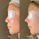 鼻プロテーゼ（隆鼻術）＋鼻尖形成＋鼻中隔延長術 after画像 サムネイル用