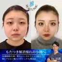 脂肪吸引(頬・顎下)/バッカルファット除去/顎ヒアルロン酸/エラボトックス/二重埋没法 after画像 サムネイル用