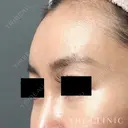 おでこの脂肪注入（CRF注入） after画像 サムネイル用