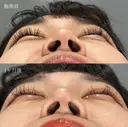 TCB式鼻翼縮小完全内側法・外側法＋鼻尖形成 after画像 サムネイル用