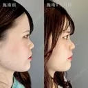 TCB式鼻翼縮小完全内側法・外側法＋鼻尖形成＋鼻プロテーゼ（隆鼻術）＋切らない小鼻縮小（鼻翼縮小埋没法） after画像 サムネイル用