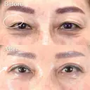 目の上のたるみ取り（上眼瞼除皺術）＋クマ取り再生注射 after画像 サムネイル用
