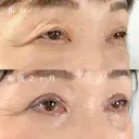 目の上のたるみ取り（上眼瞼除皺術） after画像 サムネイル用