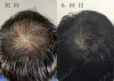 AGA治療（薄毛治療） after画像 サムネイル用