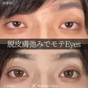 脱皮膚弛みでモテEyes👀✨ before画像 サムネイル用