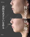 唇ヒアルロン酸 before画像 サムネイル用