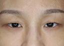 【20代女性・左右差をなくして綺麗な二重に】マイクロメソッド＋α（1ヶ月後） before画像 サムネイル用