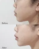 Eライン形成 before画像 サムネイル用
