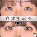 自然癒着法（二重埋没） after画像 サムネイル用