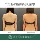 カリカリボディを目指す💉オアシスコンプリート脂肪吸引（上腕全周〜お背中一部）🌴 after画像 サムネイル用