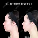 頬・顎下脂肪吸引/糸リフト before画像 サムネイル用