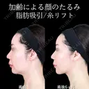 頬・顎下脂肪吸引/糸リフト 180日後 サムネイル用
