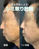 シミ取り放題 before画像 サムネイル用