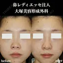 鼻レディエッセ注入 after画像 サムネイル用
