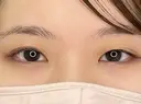 【二重埋没】自然癒着法 before画像 サムネイル用
