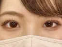 【二重埋没】自然癒着法 30日後 サムネイル用