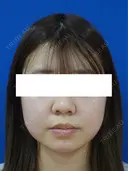 鼻尖縮小 before画像 サムネイル用