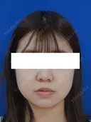 鼻尖縮小 30日後 サムネイル用
