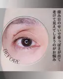脂肪注入(目の上) before画像 サムネイル用