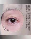 脂肪注入(目の上) 7日後 サムネイル用
