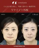 【輪郭整形】Vライン＋外板切除　たるみを最小限に、年齢で諦めない輪郭形成 before画像 サムネイル用
