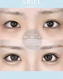 アリエルクイックループトリプル二重埋没法 before画像 サムネイル用