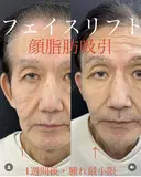 フェイスリフト＋顔脂肪吸引 after画像 サムネイル用
