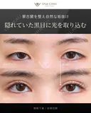 眼瞼下垂 / 目頭切開 180日後 サムネイル用