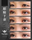 眼瞼下垂 / 目頭切開 before画像 サムネイル用