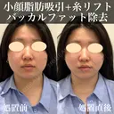 小顔脂肪吸引・除去＋糸リフトでパーフェクト小顔に！！ 30日後 サムネイル用