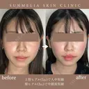 唇ヒアルで人中短縮×頬ヒアルで中顔面短縮 after画像 サムネイル用