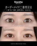 オーダーメイド二重埋没法＋選べる１施術（目頭切開法：左目のみ） 30日後 サムネイル用