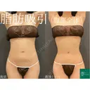 コンプリート脂肪吸引（上下腹部ウエスト腰）自然な範囲でしっかりと吸引🌴 after画像 サムネイル用