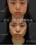 ボトックス治療（エラ・アゴ） after画像 サムネイル用